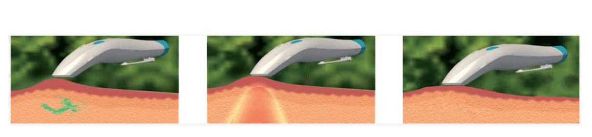 Bite Away insect bite healer