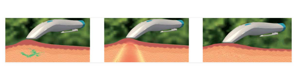 Bite Away insect bite healer